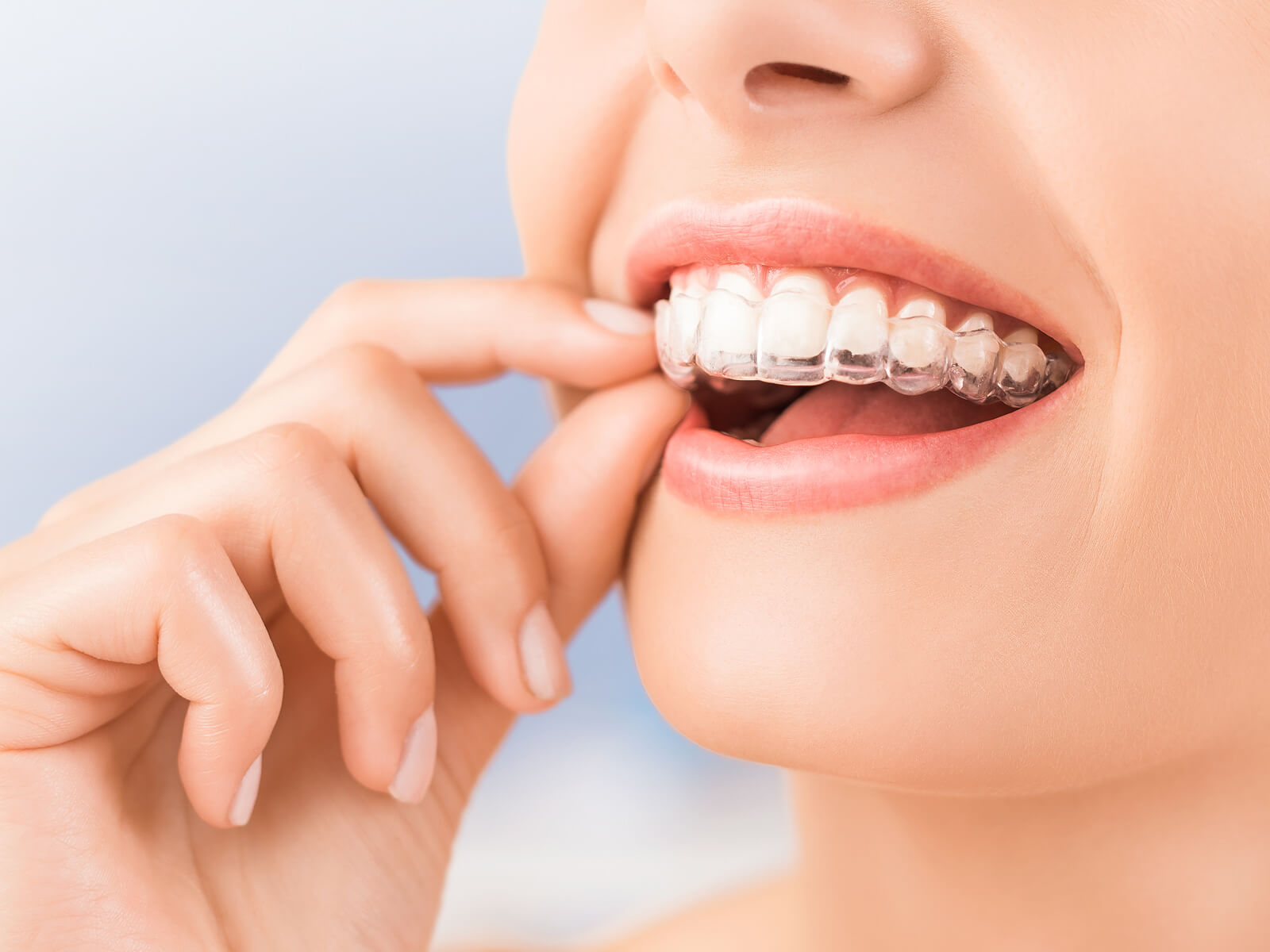 Do teeth go yellow with Invisalign?