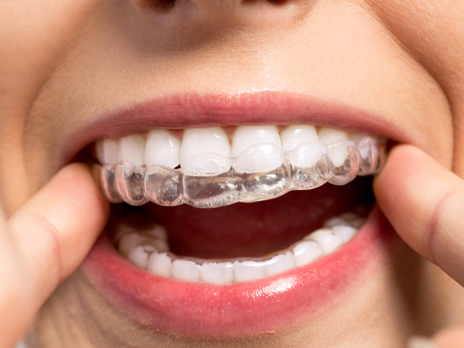 The importance of Oral Hygiene During Invisalign Treatment