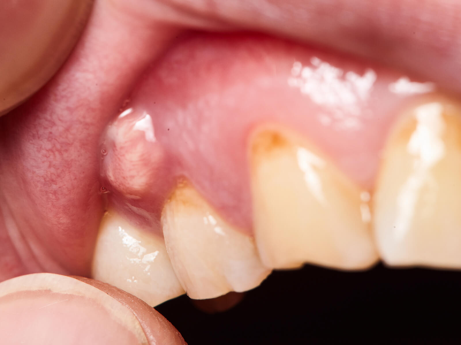 How Does A Tooth Abscess Affect My Oral And Overall Health?