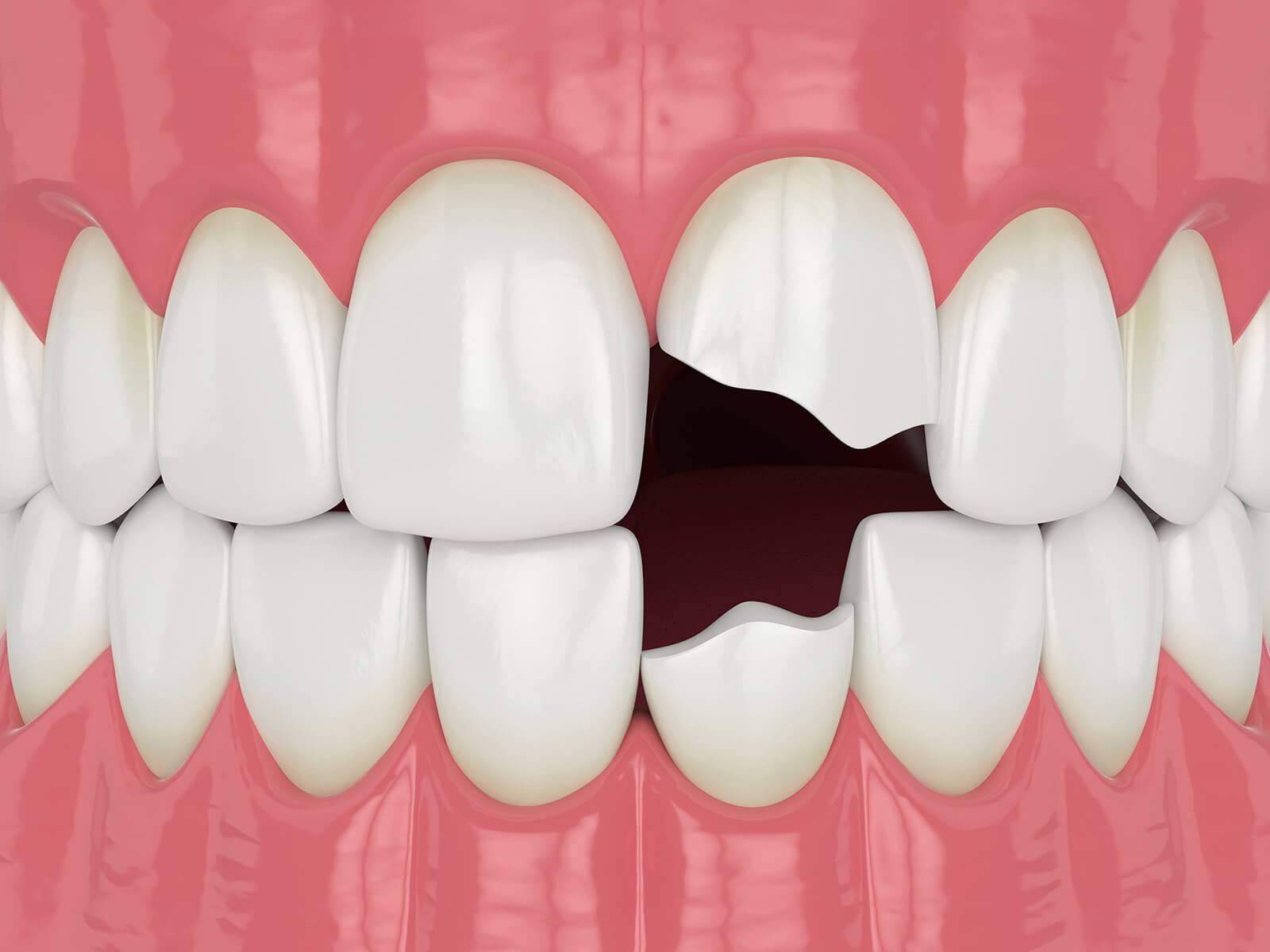What Happens To Tooth Enamel With A Chipped Tooth?