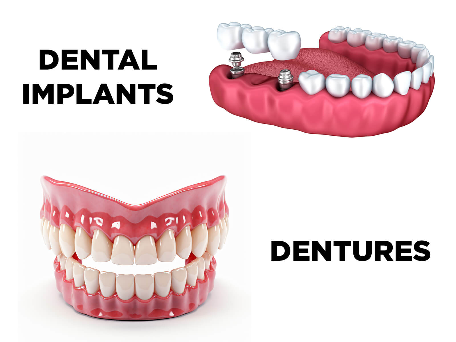 Should I Get Dentures or Dental Implants