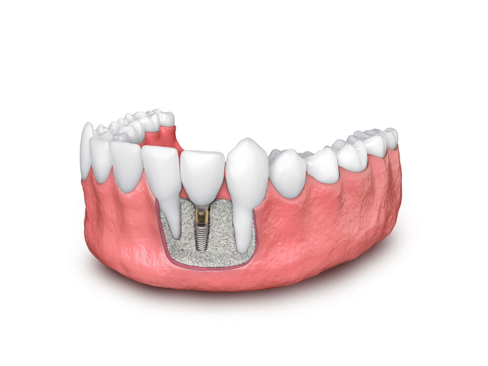 Dental Implants And Bone Health: Understanding Bone Grafting