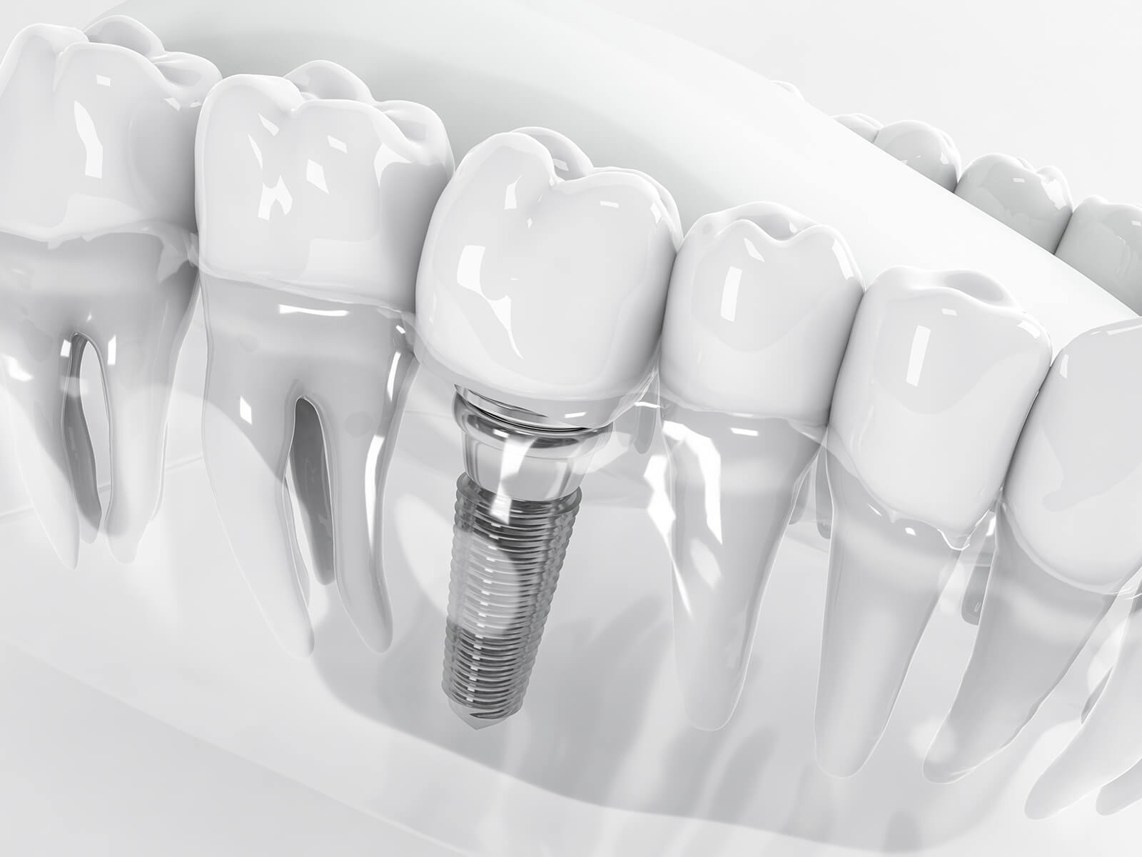 Regain Your Oral Health With Dental Implants