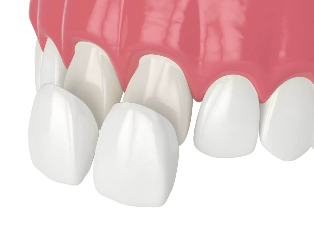 Common Mistakes That Can Damage Your Veneers