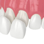 Common Mistakes That Can Damage Your Veneers