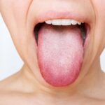 What To Do When You Burn Your Tongue?