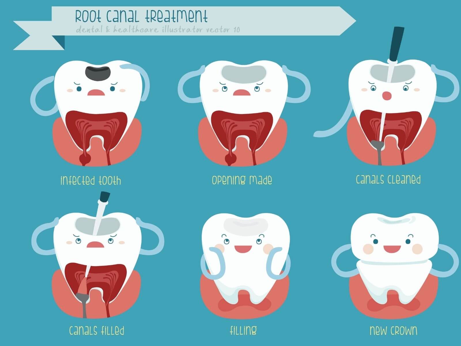 Exploring Alternatives To Root Canal: What Are Your Options?