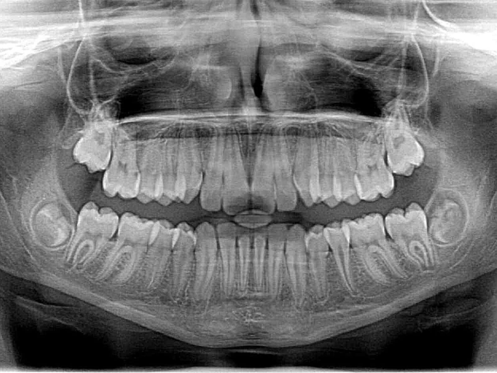 Are Dental X-Rays Safe During Pregnancy? Expert Advice