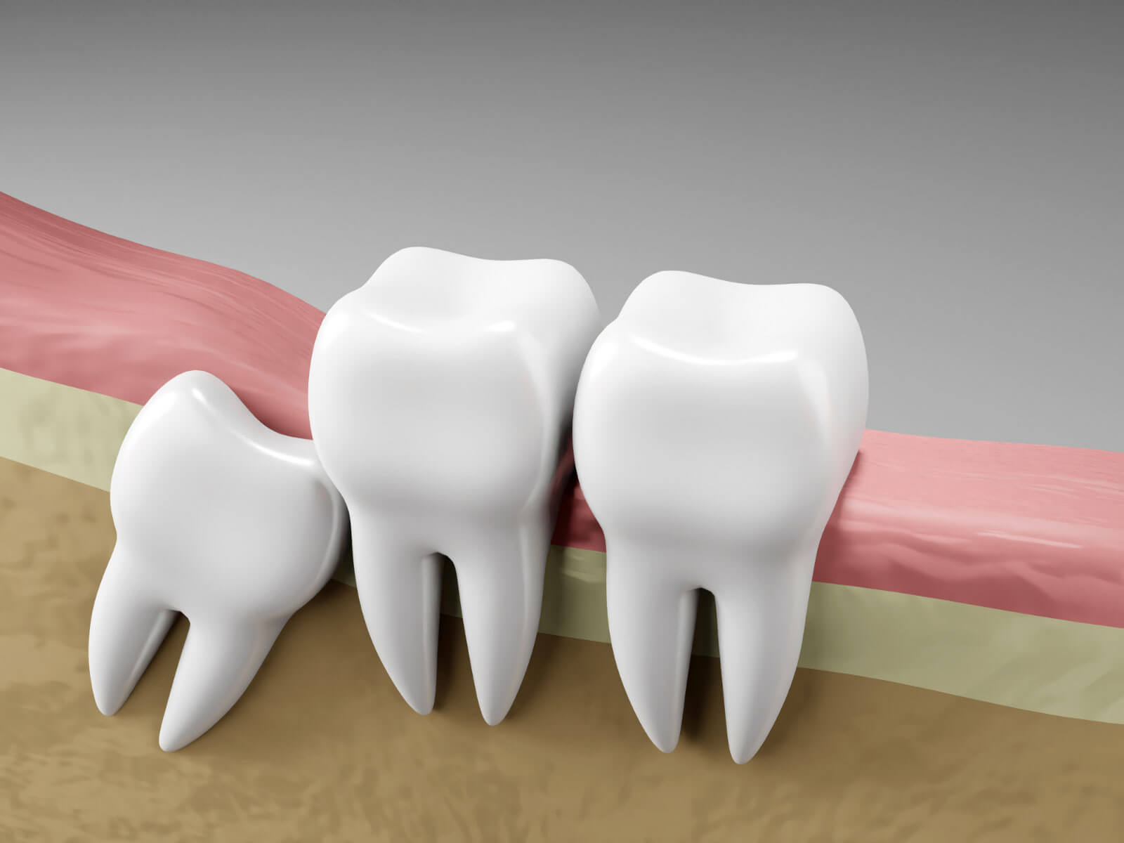 7 Signs Your Wisdom Teeth Are Coming In