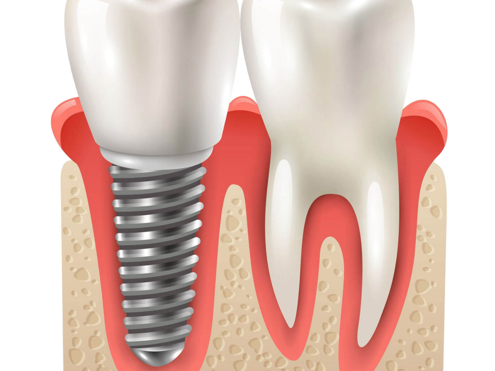 5 Types of Dental Implants Explained