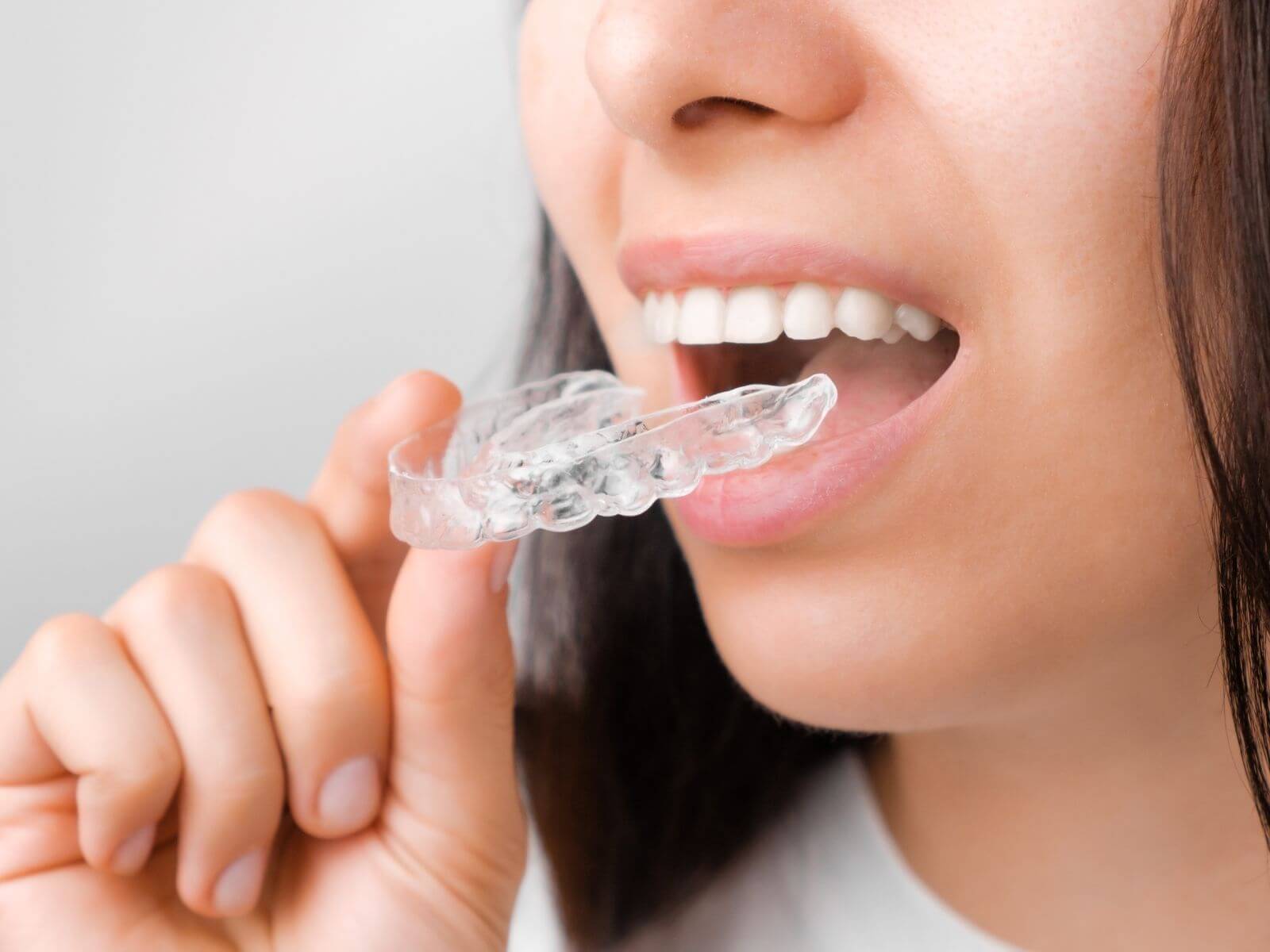 How Long Does Invisalign Take? A Realistic Treatment Timeline