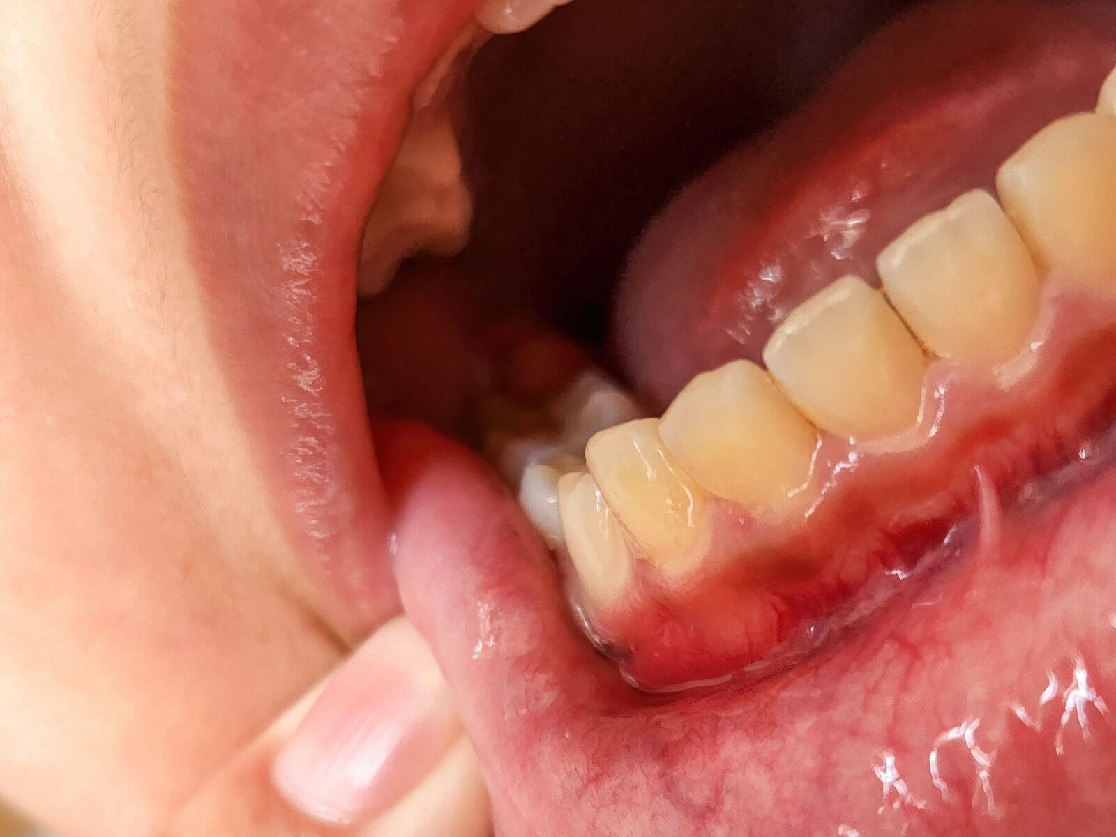 How to Stop Bleeding Gums: Causes, Home Remedies, and Treatment