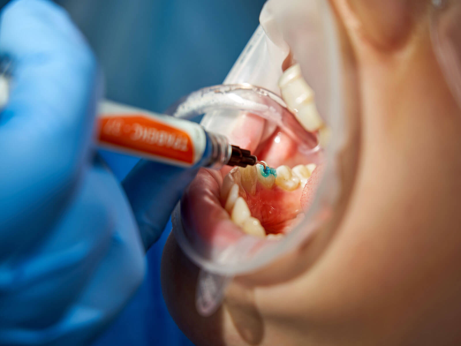 10 Benefits of Dental Sealants for Kids