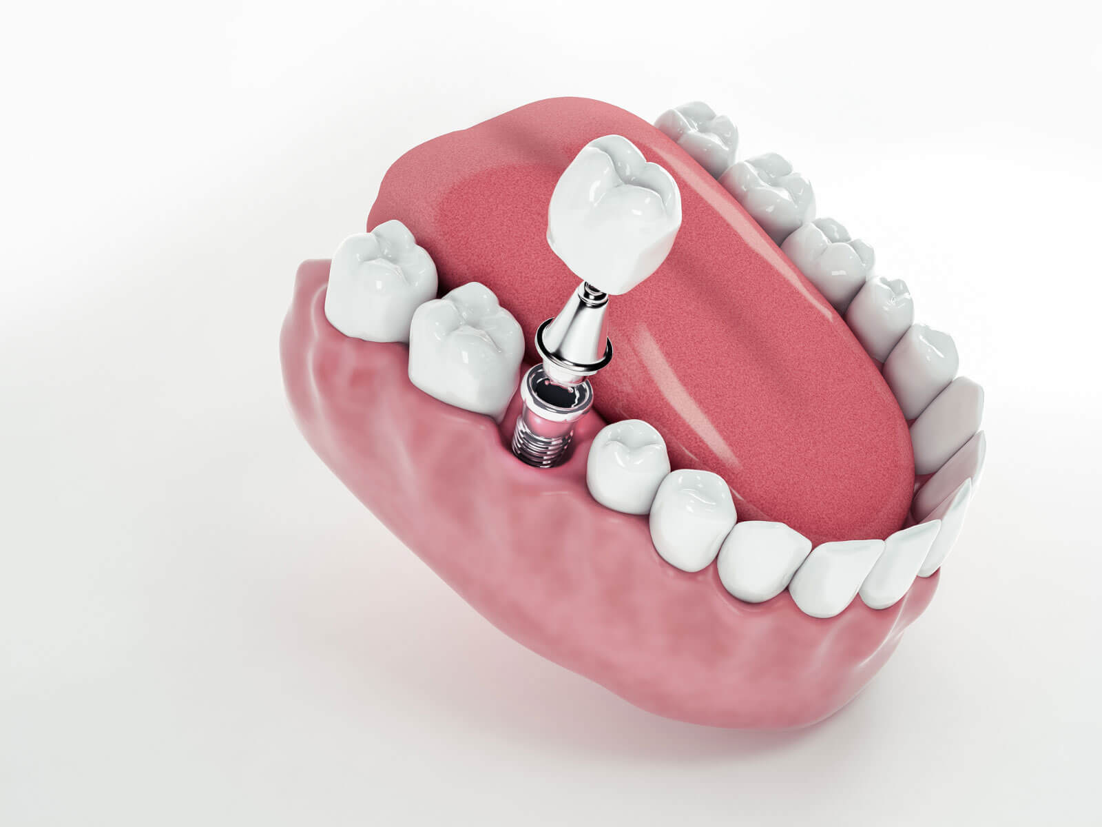 Cost of Full Mouth Dental Implants in 2026: All-on-4 vs. All-on-6 Pricing